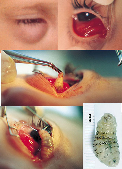 Eye worm removal