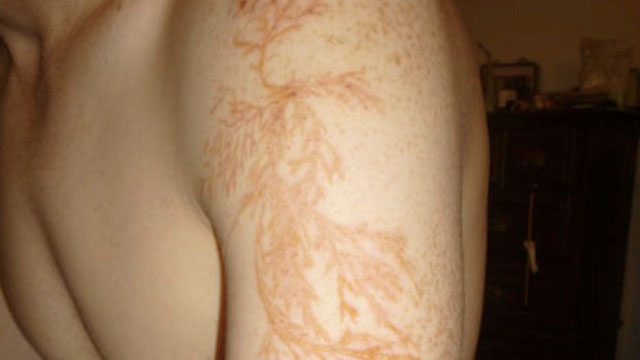 You get a fractal tattoo after being struck by lightning it's called a Lichtenberg figure