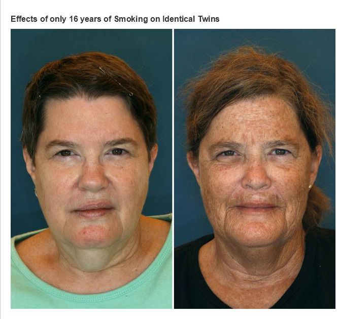 Fascinating photos - twins smoker and non smoker - Effects of only 16 years of Smoking on Identical Twins
