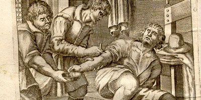 4. Bloodletting-Basically the theory was that the body was filled with four fluids blood, phlegm, yellow bile and black bile called humours and that any imbalance in the four was the root of all illness. Apparently blood can be a bit of a space hog and thus often some had to be bled out to make room for more fun stuff like phlegm and black bile a.k.a. diarrhea, or so the theory went