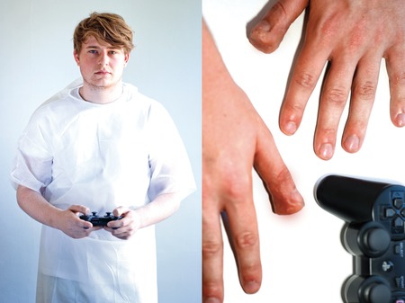 Though this ailment is often called "Playstation Thumb," the condition can affect anyone who uses a game with a d-pad controller. Symptoms of PlayStation Thumb include numbness and tingling in the thumb and large, open blisters caused by repetitive motion that require weeks to heal.