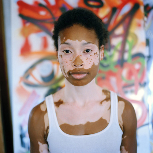 Black woman with vitiligo by Sembene McFarland.