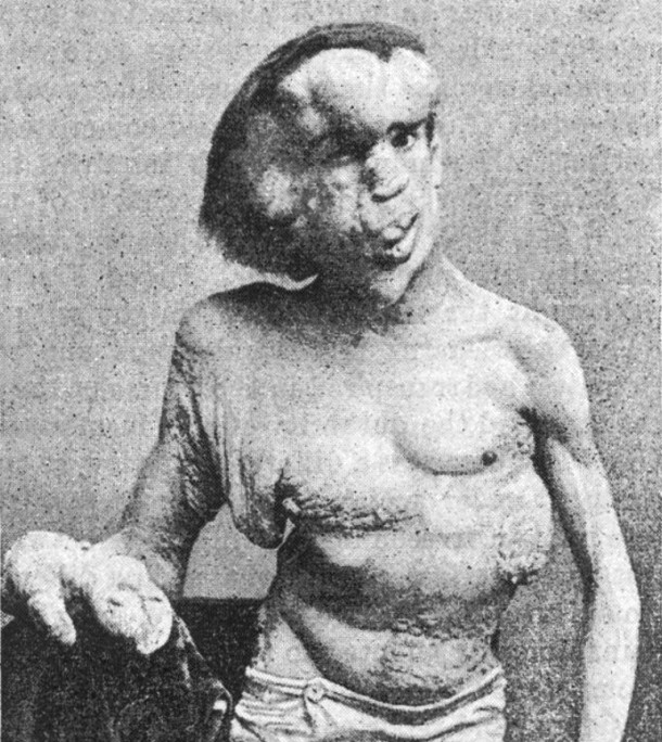 The Elephant Man-Joseph Merrick (1862 – 1890) was an Englishman who, due to his genetic anomalies, was nicknamed The Elephant Man. His skin appeared thick and lumpy, he developed an enlargement of his lips, and a bony lump grew on his forehead. The exact cause of these anomalies is unknown, however, modern doctors suggest it was a combination of several diseases such as neurofibromatosis type I and Proteus syndrome.