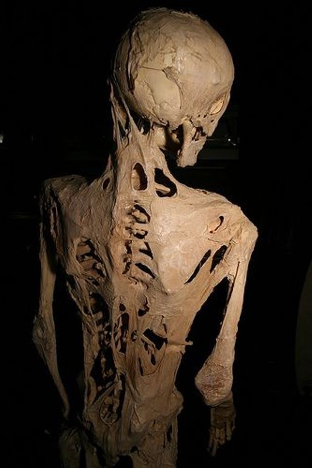 Stone Man Syndrome-Officially known as Fibrodysplasia ossificans progressiva (FOP), Stone Man Syndrome (or Stone Man Disease), is an extremely rare disease of the connective tissue. In people who suffer from this disease, bone tissue grows where muscles, tendons, and other connective tissues should be, effectively restricting movement of the patients who, gradually, become living statues