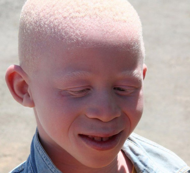 Albinism is a congenital disorder characterized by the complete or partial absence of pigment in the skin, hair and eyes. The disease itself doesn’t cause mortality – people afflicted with albinism are generally healthy but the lack of pigment blocking ultraviolet radiation increases the risk for skin cancers, visual defects and other problems. The occurrence of albinism is very rare though – in the US and Europe, less than 5 out of 100,000 people suffer from this disorder