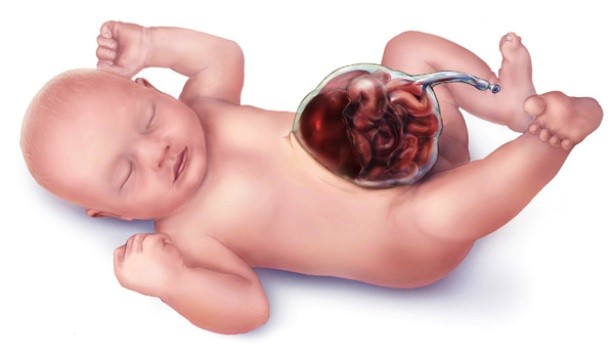 Gastroschisis is a congenital disorder characterized by a defect in the anterior abdominal wall through which the abdominal contents freely protrude. Typically, the abdomen encases the internal organs as the fetus ages, but sometimes, the abdominal wall doesn’t do this correctly and some of the fetus’s organs end up stuck outside its body. Although it sounds scary, these days, the survival rate of such condition is 90 percent.
