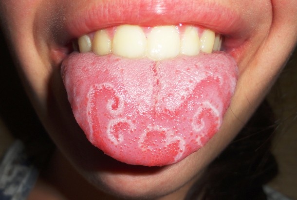 Geographic tongue-Known as erythema migrans or wandering rash of the tongue, the geographic tongue is a harmless condition characterized by areas of smooth, red depapillation which migrate over time. The disease got its name after the map-like appearance of the tongue. Affecting as much as up to 3% of the general population, it is one of the most common genetic anomalies