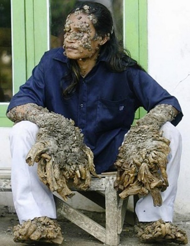 Tree man illness-Scientifically known as Epidermodysplasia verruciformis or Lewandowsky-Lutz dysplasia, the tree man illness is an extremely rare autosomal recessive genetic skin disorder characterized by abnormal susceptibility to human papillomaviruses of the skin. This condition causes scaly wood-like macules and papules to grow on the hands, feet, and even the face.