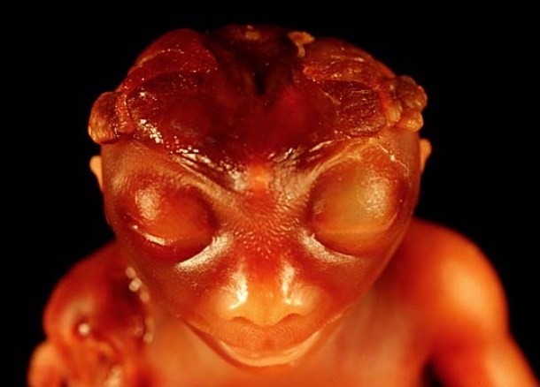 Frog-like baby-In 2006, a neck-less baby with enormous eyeballs was born in Nepal. Born to a mother of two normal daughters, the baby suffered from anencephaly, a condition that is characterize by the absence of major portions of the brain, skull, and scalp.