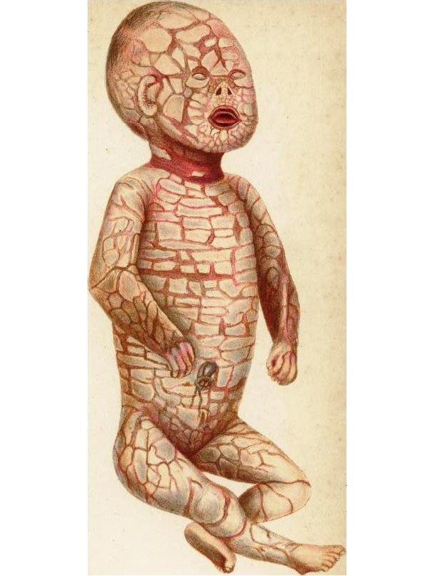 Harlequin ichthyosis is a very rare and often fatal genetic skin disorder. Babies affected with Harlequin ichtyosis are born with extremely thick plates of skin with deep red fissures over their entire bodies