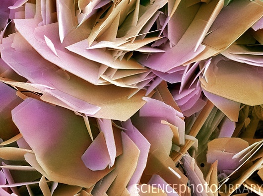 kidney stone under a microscope - Science Photo Ibrary