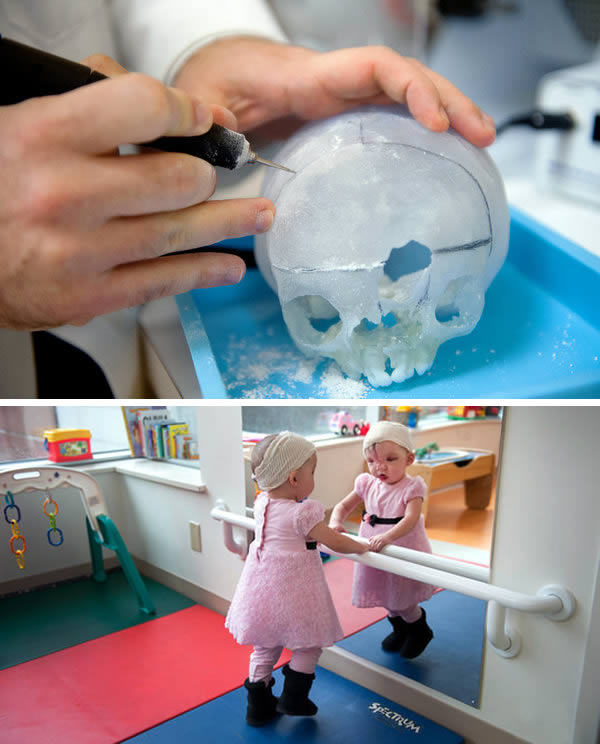 3D Printed Practicing Skulls-Dr. John Meara at Boston Children's Hospital wanted to help Violet. He had done this kind of surgery before, but every patient is different, and the bone reconstruction will be different for each one. That's where 3D printing comes in. Dr. Meara had his colleague Dr. Peter Weinstock make 3D models of the toddler's skull, using data from magnetic resonance imaging. Meara was able to practice with four skull models, in order to develop the best plan for Violet's surgery ahead of time.

Dr. Meara was able to move Violet's eyes closer together and eliminate a large hole in her forehead. She will have more surgery as she grows, but the first step was made much easier by the practice skulls.