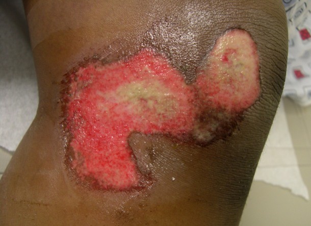 Abrasion...A type of scarification, abrasion is a practice in which layers of human skin are removed through abrasion. It can be done either mechanically (e.g. using a sandpaper) or chemically (by means of corrosive chemicals).