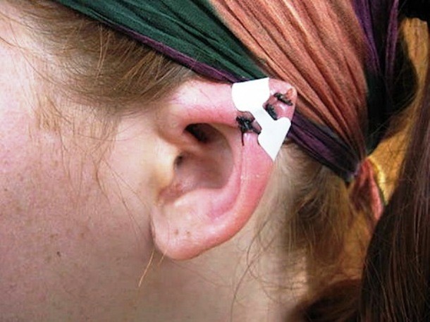 Also known as ear pointing, elfing is a body modification meant to give human ears an appearance similar to that of elves or Vulcans. A common method is to remove a small wedge-shaped portion at the top of the ear, and then suture the two edges.