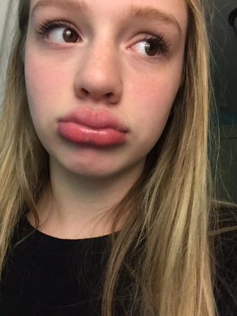 instagram kylie jenner lip challenge