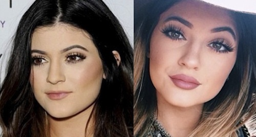 did kylie jenner get her lips done