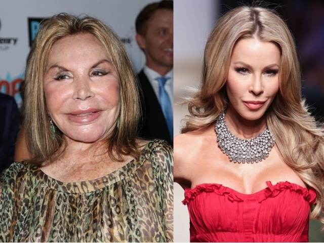 19 Celebrity Plastic Surgeries Gone Way Wrong