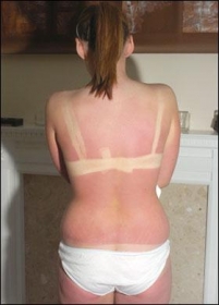 sunburn with bra