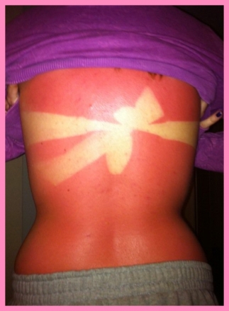 sunburn marks