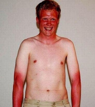 bad sunburn