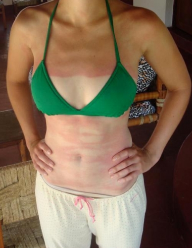sunburnt belly