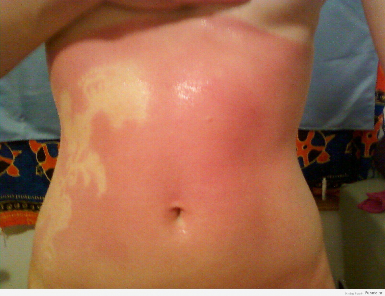 white spot on sunburn