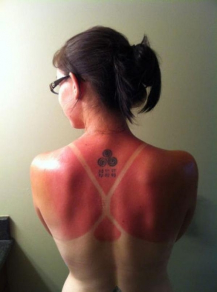 sunburn tattoo woman