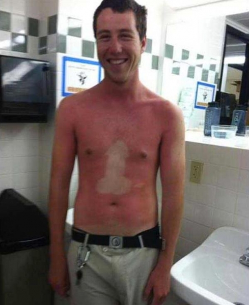 black person with sunburn