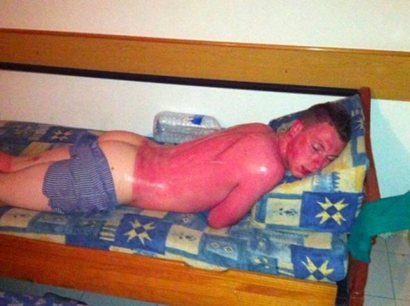 37 Times People Forgot The Sun Was Hot