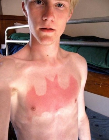 sunburn tattoo