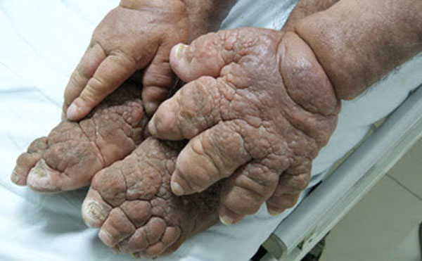 25 Most Bizarre Hands and Feet Ever!