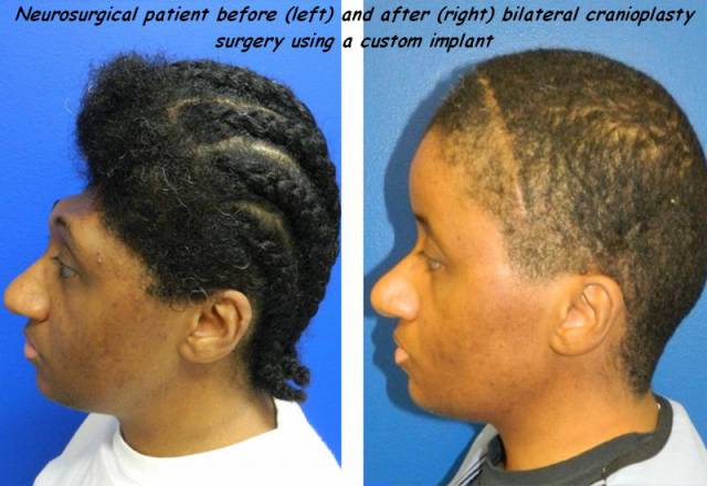 ear - Neurosurgical patient before left and after right bilateral cranioplasty surgery using a custom implant
