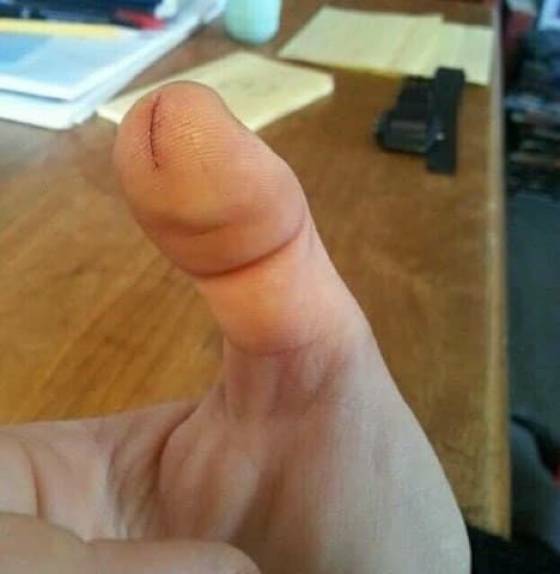 Busted up thumb that looks like a penis.