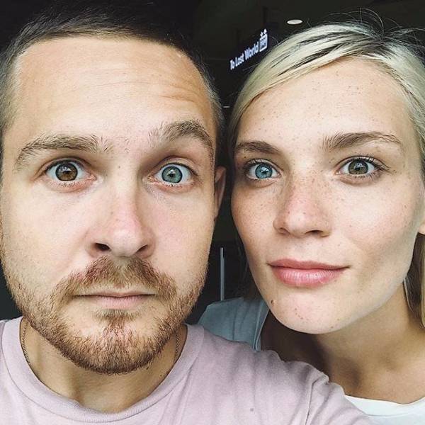 heterochromia siblings