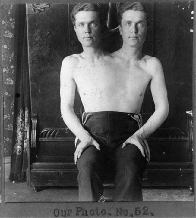 Conjoined twins marketed as "The Two-Headed Man."