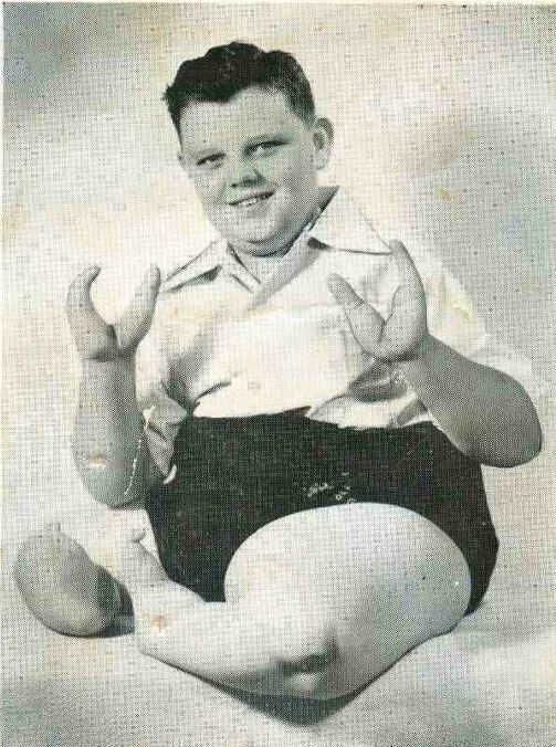 Grady Stiles suffered from etrodactyly, which caused him to develop claw-like extremities. He was given the predictable nickname "Lobster Boy."