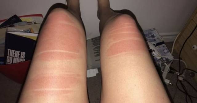 16 Girls Who Got Hilarious Sun Burns Through Their Ripped Jeans 