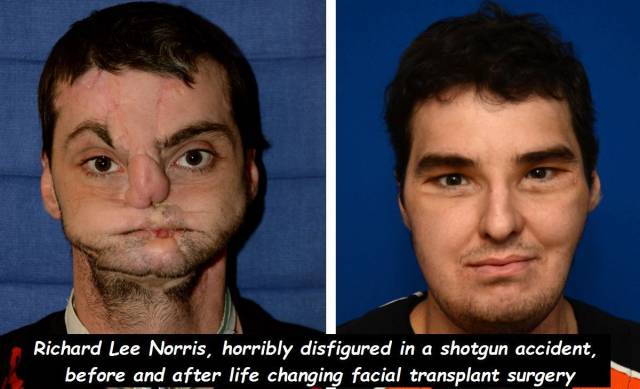 richard norris transplant - Richard Lee Norris, horribly disfigured in a shotgun accident, before and after life changing facial transplant surgery