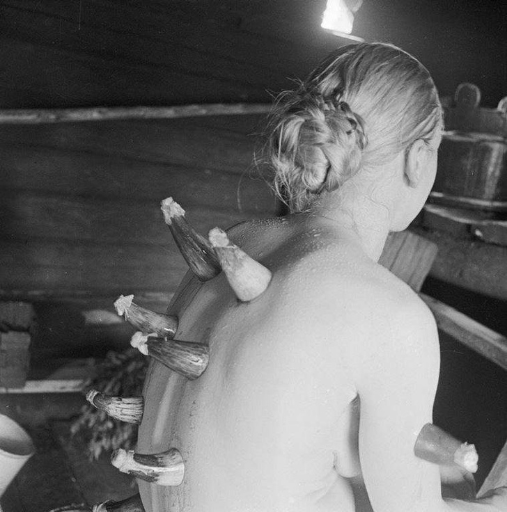 Horn cupping therapy — a form of folk medicine in Finland, 1935
