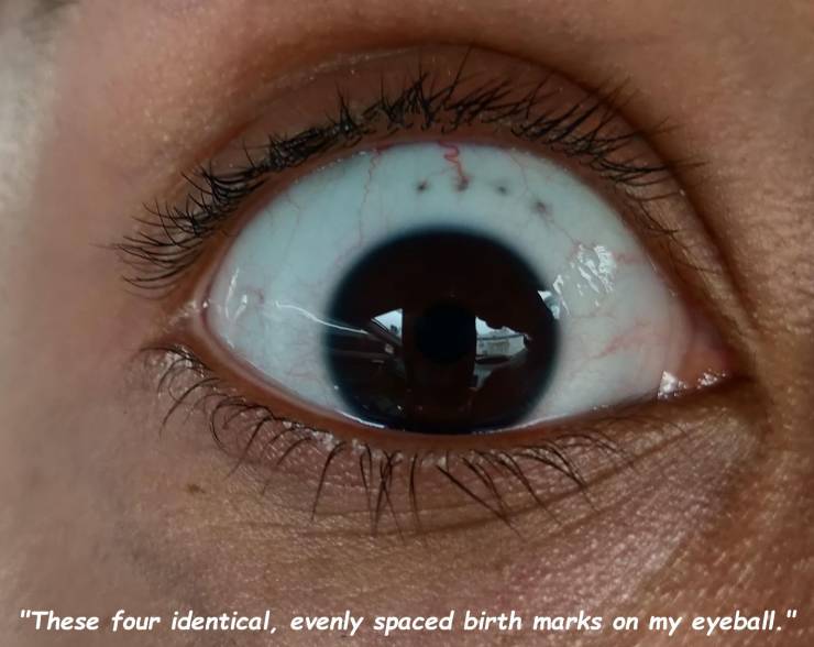Eye - "These four identical, evenly spaced birth marks on my eyeball."
