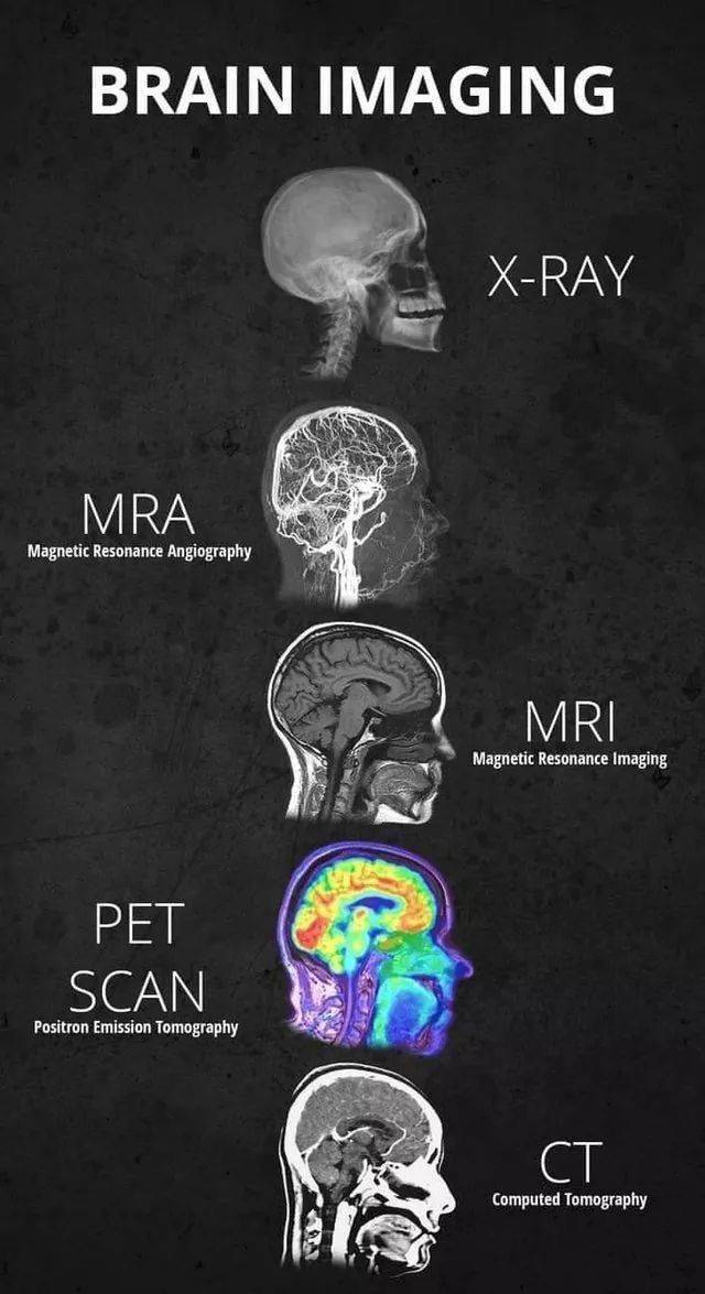 different types of brain imaging - Brain Imaging E XRay XRay Mra Magnetic Resonance Angiography Mri Magnetic Resonance Imaging Pet Scan Positron Emission Tomography Computed Tomography