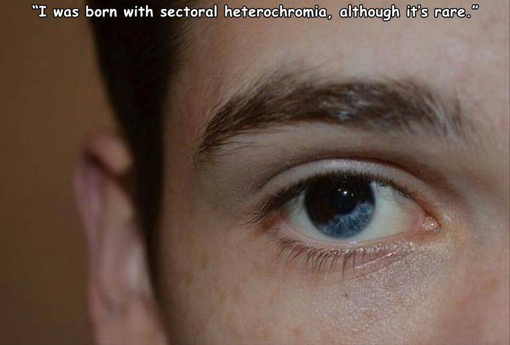 close up - "I was born with sectoral heterochromia, although it's rare."