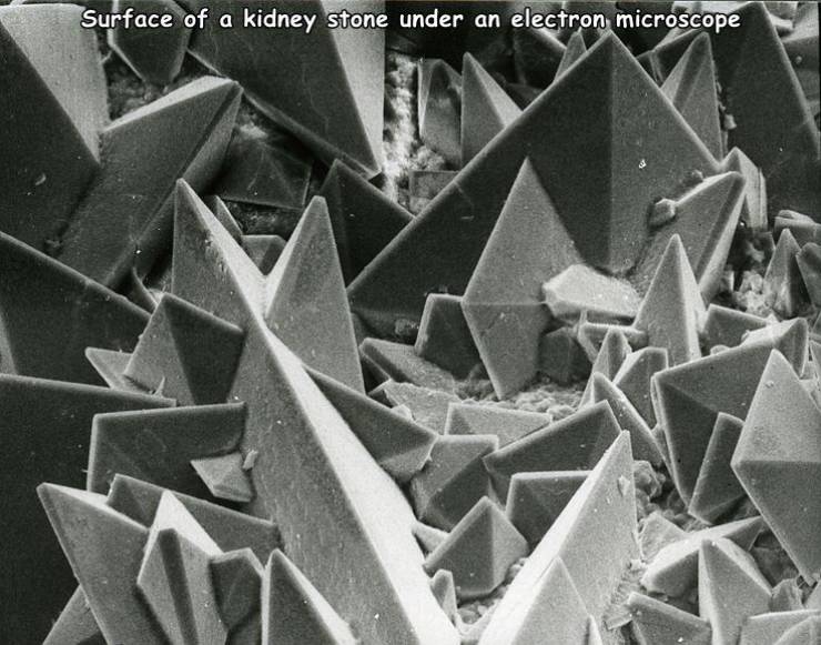 kidney stones microscope - Surface of a kidney stone under an electron microscope