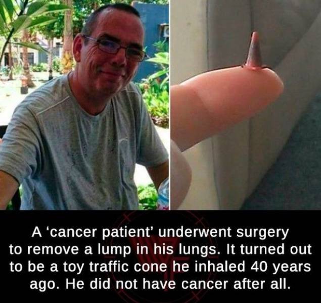 photo caption - A cancer patient' underwent surgery to remove a lump in his lungs. It turned out to be a toy traffic cone he inhaled 40 years ago. He did not have cancer after all.