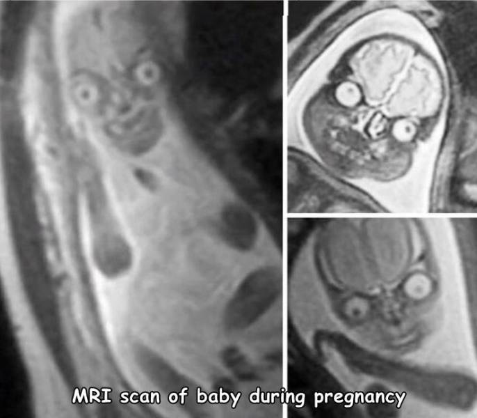 mri pregnancy - Mri scan of baby during pregnancy