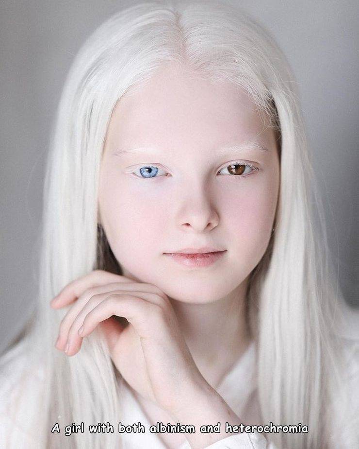 fun randoms - amina ependieva - A girl with both albinism and heterochromia