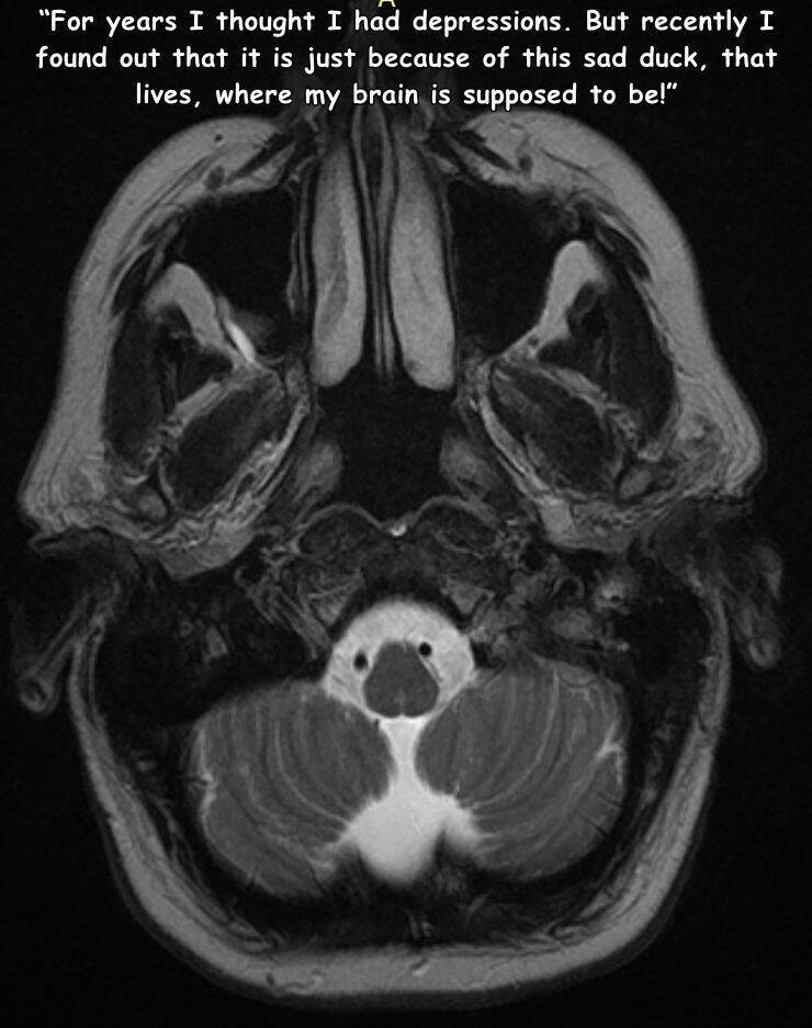 random pics - computed tomography - "For years I thought I had depressions. But recently I found out that it is just because of this sad duck, that lives, where my brain is supposed to be!"