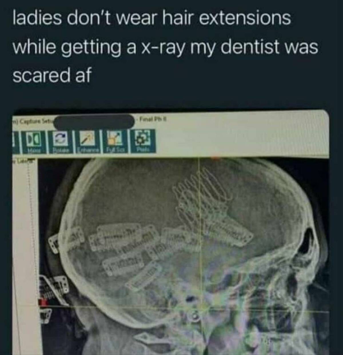 radiology - ladies don't wear hair extensions while getting a xray my dentist was scared af m Capture Setu T De Bolds Futsa Final Ph Firs