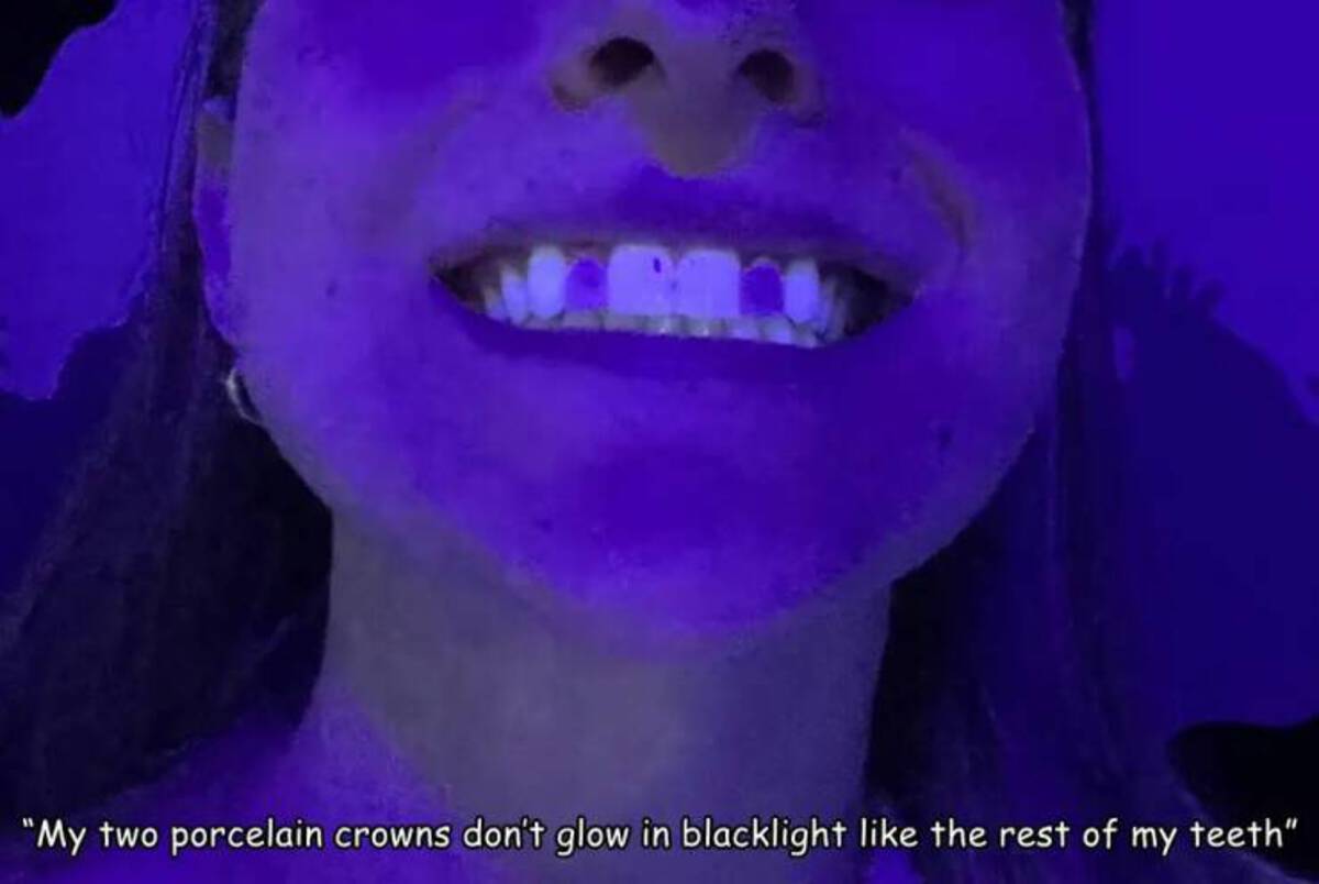 girl - "My two porcelain crowns don't glow in blacklight the rest of my teeth"
