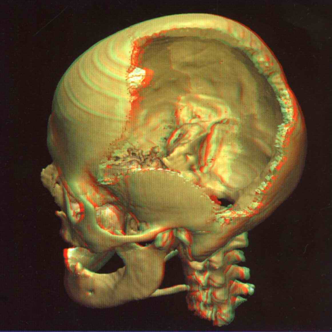3d brain damage skull fracture